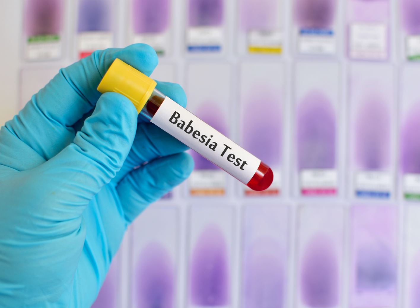 Babesia Test