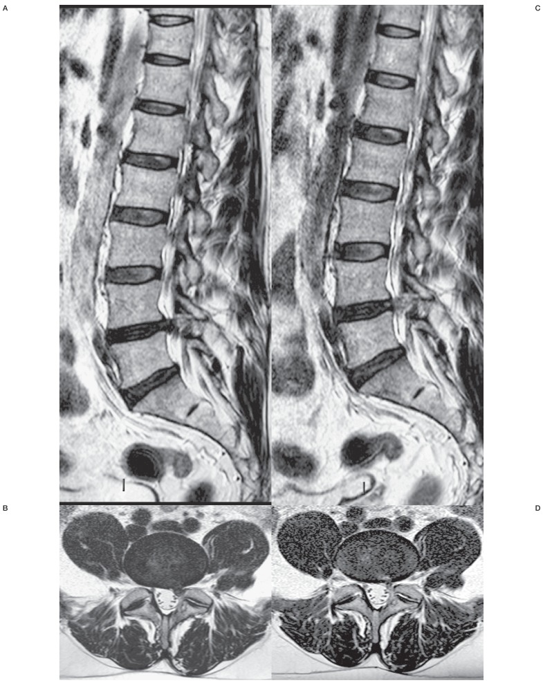 MR scans in patients after O2-O3 treatment for recurrent herniated disc.T2-weighted FSE sagittal (C) and axial (D) acquisitions 6 months after treatment showing a marked shrinkage of the herniated disc with a disappearance of L5 root compression.